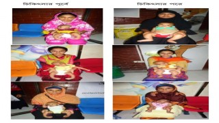 শিশুদের জন্মগত ক্রটি ক্লাব ফুট ও তার আধুনিক চিকিৎসা শিশুদের জন্মগত ক্রটি ক্লাব ফুট ও তার আধুনিক চিকিৎসা