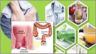 ৬টি ঘরোয়া উপায়ে অর্শরোগ বা পাইলস নিরাময়...